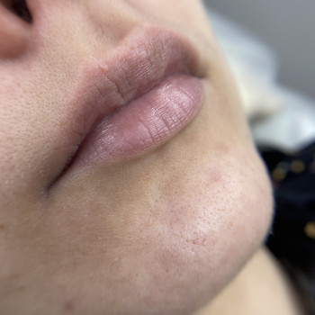 До
Не ярко выраженная арка купидона 
Небольшой шрамик 
Хо