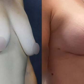 Увеличение груди