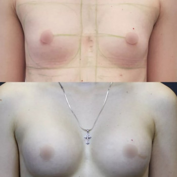 Уменьшение груди