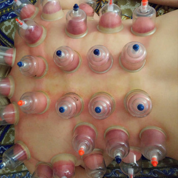 Вакуумные банки