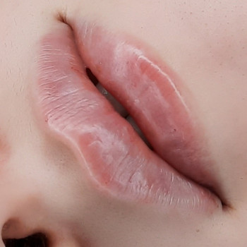 Контурная пластика  губ