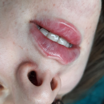 Контурная пластика губ 