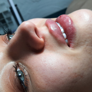 Контурная пластика губ 