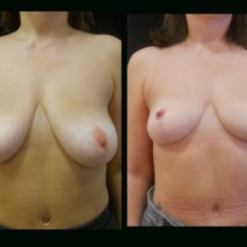 Увеличение груди