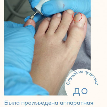 Аппаратная обработка ногтевой пластины с онихолизисом + санация ногтевого ложа