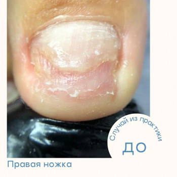 Протезирование ногтя если производится совместно с педикюром