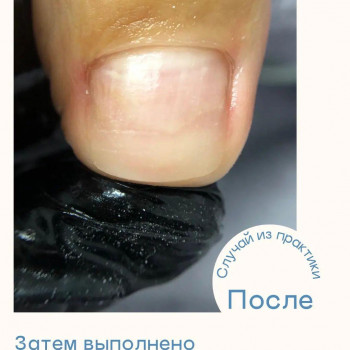 Протезирование ногтя если производится совместно с педикюром
