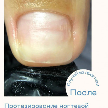 Протезирование ногтя если производится совместно с педикюром
                    Подолог Галина Дьякова Краснодар