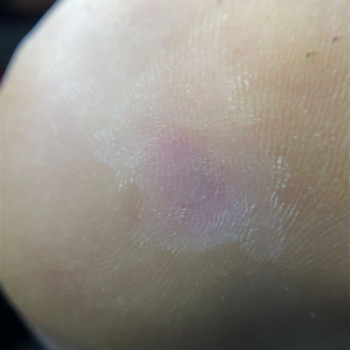 Первичная обработка бородавки
                    Podolog Галина Дьякова Krasnodar