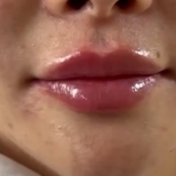 Аугментация губ