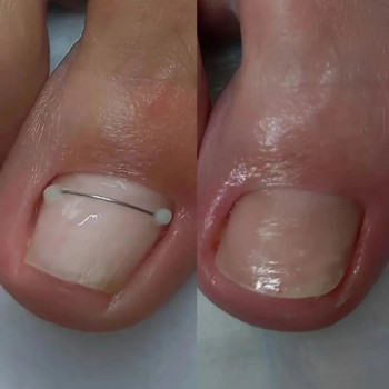 Протезирование ногтевых пластин
