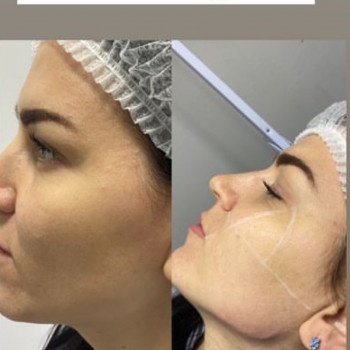 Facial Mesotherapy