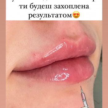 Lip augmentation