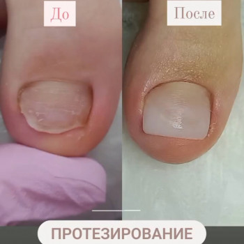 Протезирование ногтевых пластин