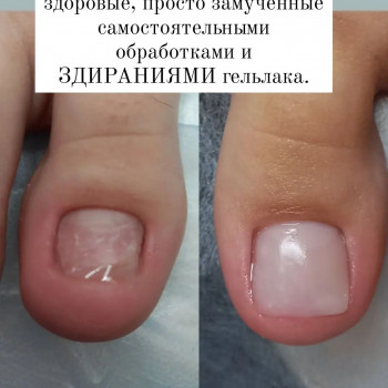 Протезирование ногтевых пластин
                    Подолог Александра Дробот Хабаровск
