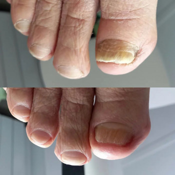 Обработка ногтевых пластин, пораженных грибком
                    Podologist Александра Дробот Khabarovsk