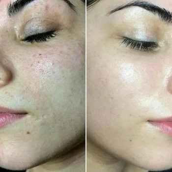 Oczyszczanie skóry twarzy