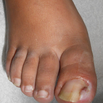 чистка ногтей