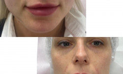 Увеличение губ Injection Beautician Yana Skobtsava Warsaw
