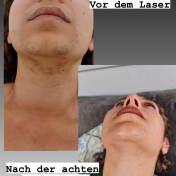 Лазерная эпиляция плечей / жен.