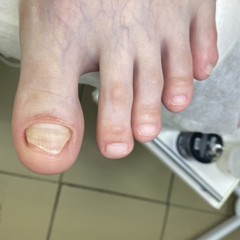 Зачистка онихолизиса 