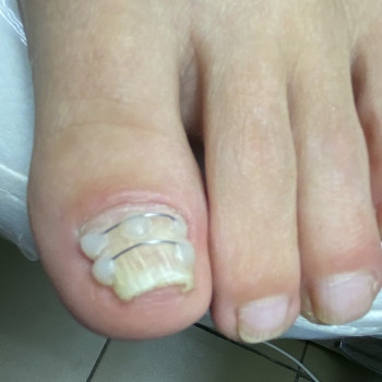 Установка титановой нити для коррекции деформированного ногт