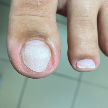 Зачистка онихолизиса 