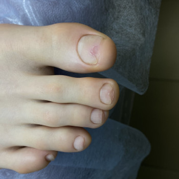 Зачистка онихолизиса 