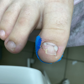 Коррекция вросшего ногтя 
Установка титановой нити
Установ