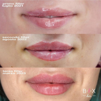 Botox Bar, Рим Фото - 5