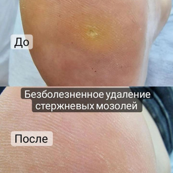 Удаление стержневой мозоли
                    Podologist Гузель Асатова Naberezhnye Chelny