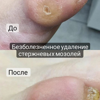Удаление стержневой мозоли
                    Podologist Гузель Асатова Naberezhnye Chelny