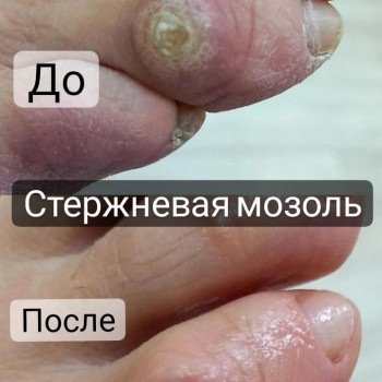 Удаление стержневой мозоли
                    Podologist Гузель Асатова Naberezhnye Chelny