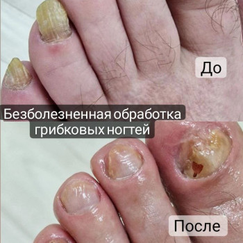 Обработка грибковых ногтей
                    Podologist Гузель Асатова Naberezhnye Chelny