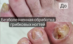 Обработка грибковых ногтей Podologist Гузель Асатова Naberezhnye Chelny