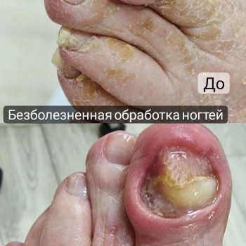 Обработка грибковых ногтей
                    Подолог Гузель Асатова Набережные Челны