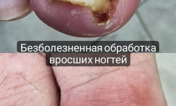 Обработка вросшего ногтя Podolog Гузель Асатова Naberezhnye Chelny