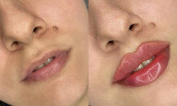 Увеличение губ Lashmaker Yulia Sokarava Warsaw