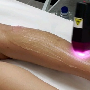 Лазерная эпиляция кистей рук / жен.