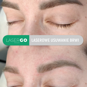 Laserowe usuwanie makijażu permanentnego