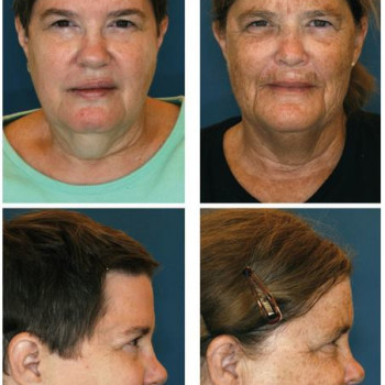 Reface Laitlift, Ramat Gan Фото - 5