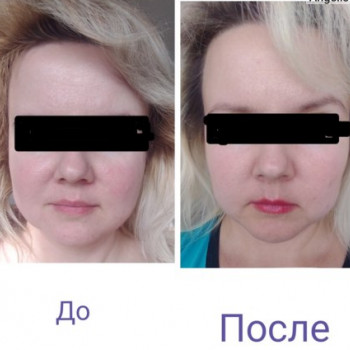 Reface Laitlift, Ramat Gan Фото - 6