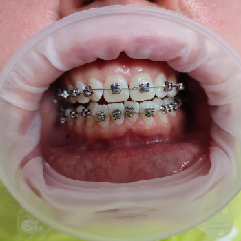 Фторирование зубов
