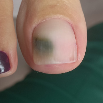 Последствие ношения гель-лака. Псевдомония или синегнойка.