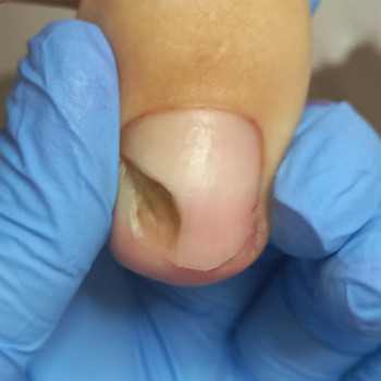 Опасна- если оставить без внимания НЕЛЬЗЯ ПОКРЫВАТЬ! 