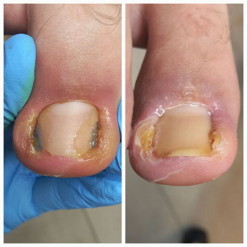 Разница между фото 30 минут.
Отёк меньше.
НЕ БОЛИТ!!