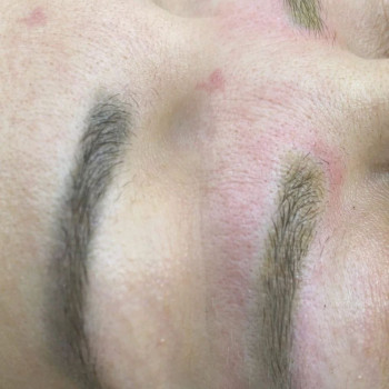 Удаление лазером