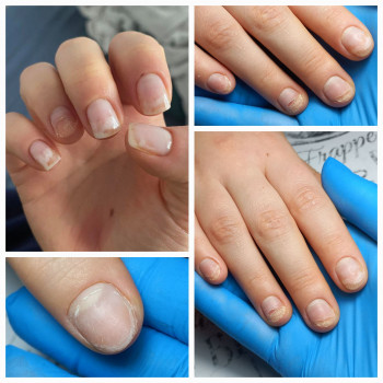 Восстановление ногтей после гель-лака. Динамика за 2 недели 