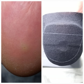 Разгрузка пятки при болях во время ходьбы (бородавка)