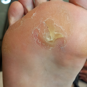 Ожег в результате нанесения пластырей и мазей от мозолей☝️
